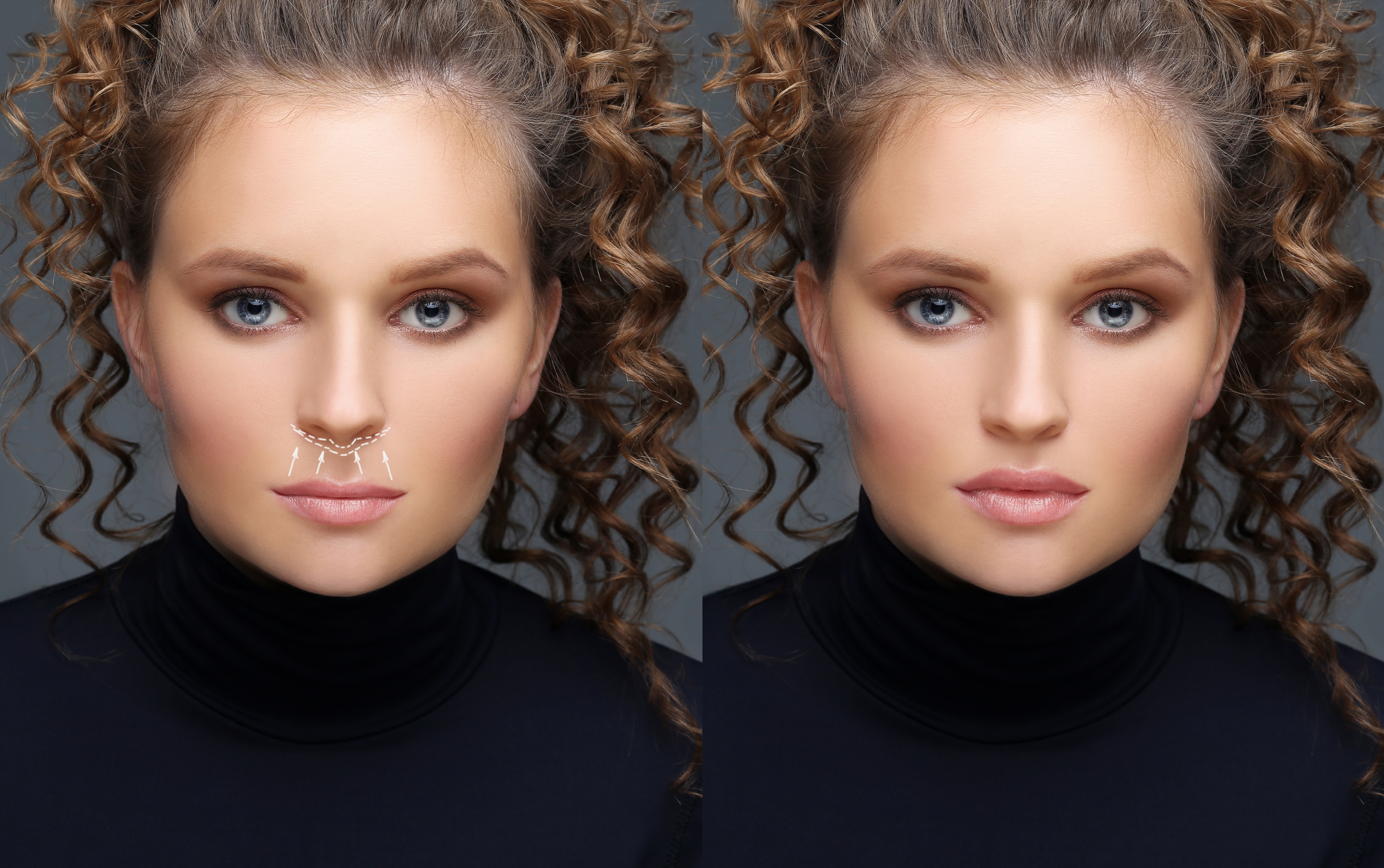 chirurgische liplift chirurgische liplift